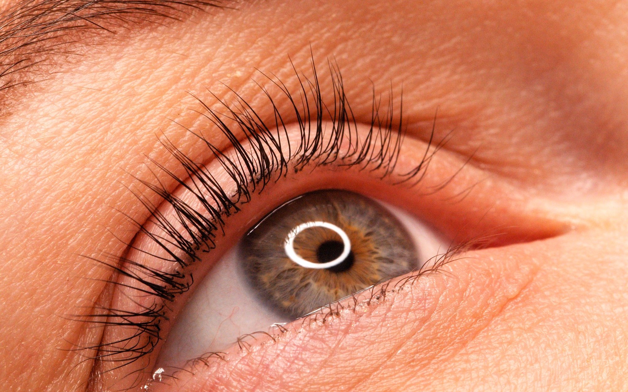 LASIK chirurgie Réfractive